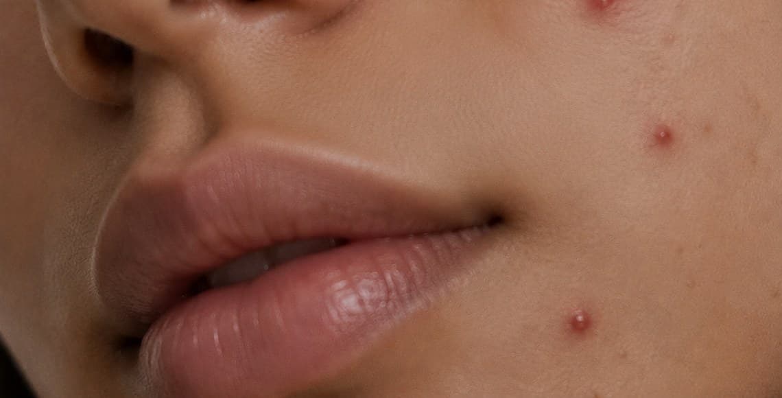 Close-up of skin with active acne lesions