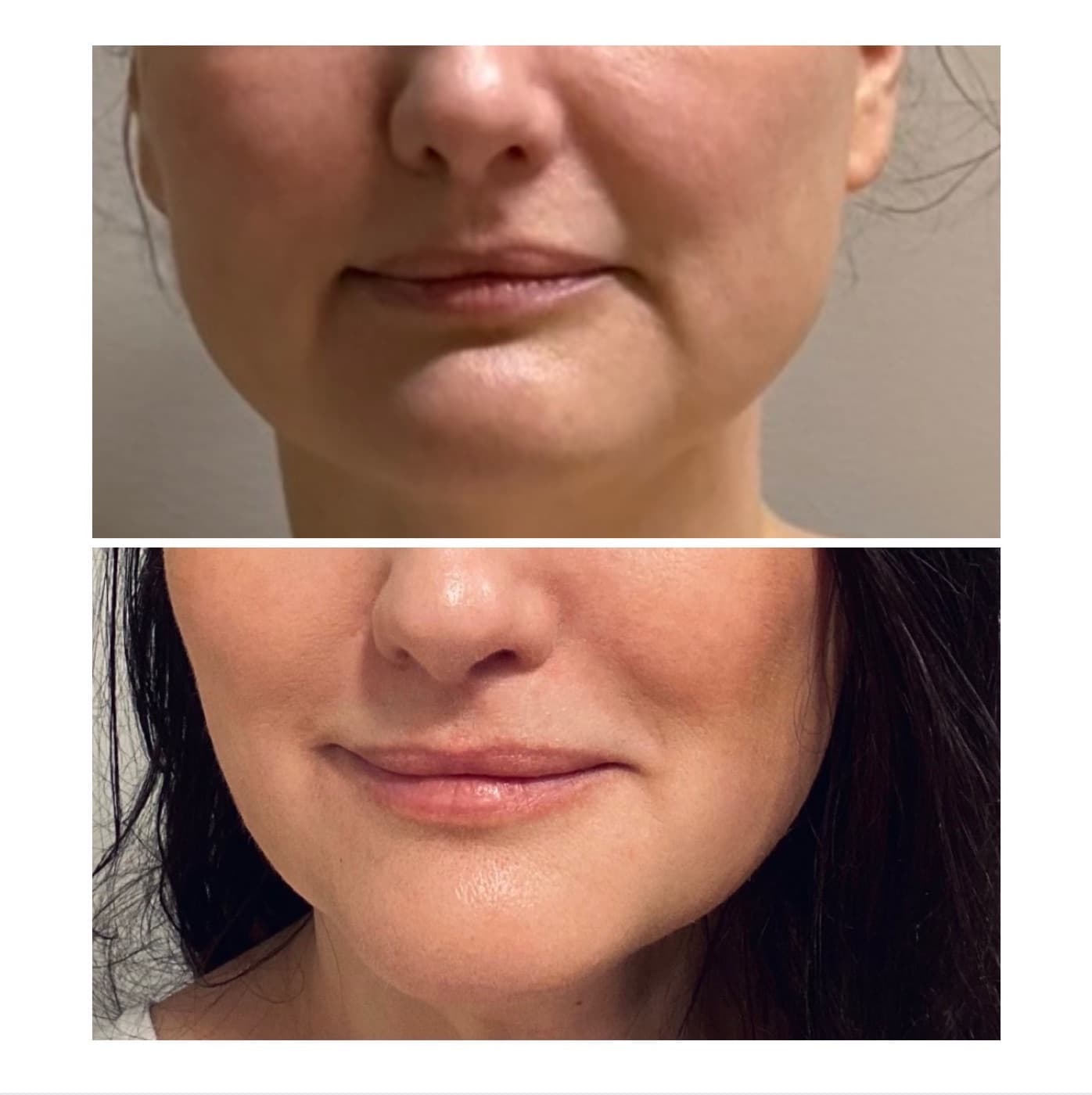 HIFU Cheek Contour + Nasolabial Lift — Salmon Arm Aesthetics, Salmon Arm BC