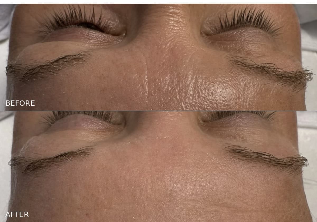 HIFU Eyelid & Eyebrow Lift — Salmon Arm Aesthetics, Salmon Arm BC