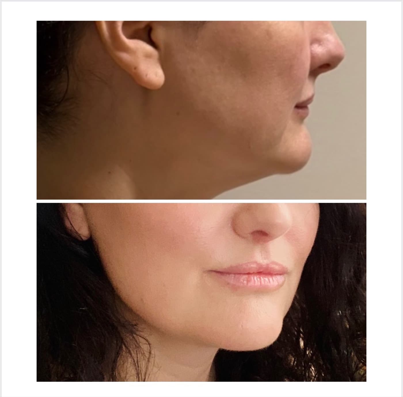 HIFU Jowl Reduction — Salmon Arm Aesthetics, Salmon Arm BC