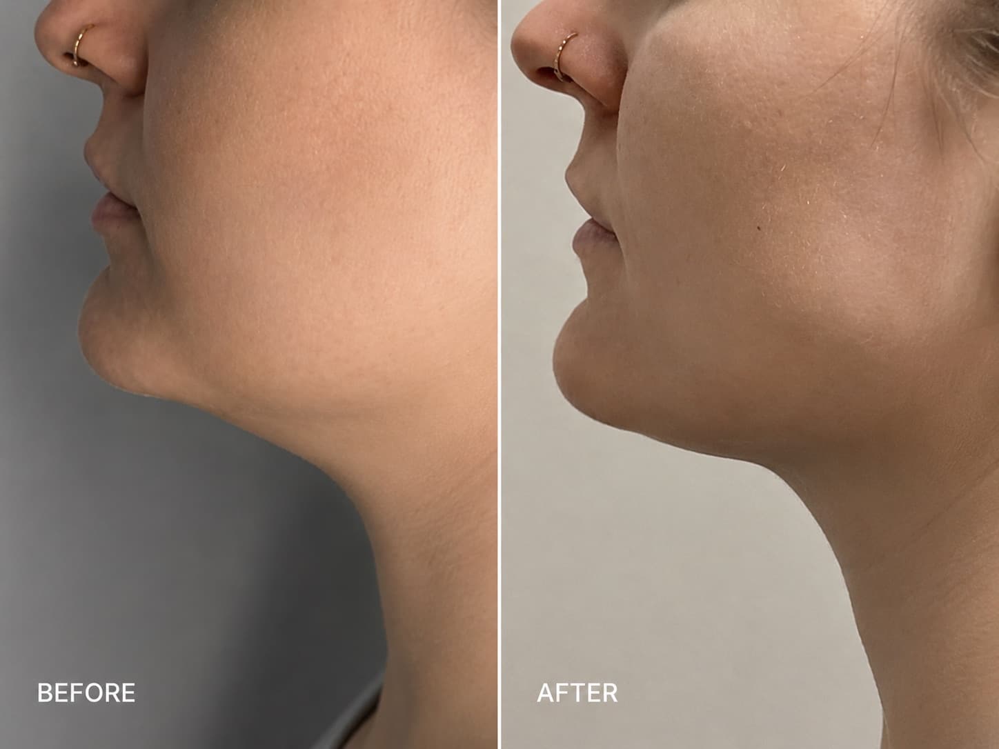 HIFU Neck Lift / Double Chin — Salmon Arm Aesthetics, Salmon Arm BC