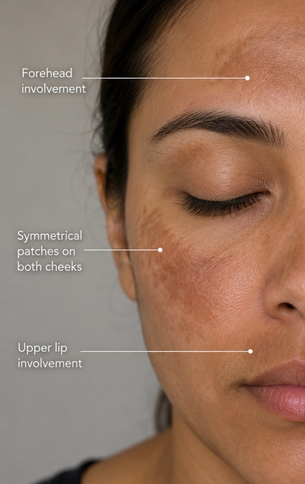 Melasma & Pigmentation Laser Treatment — Salmon Arm Aesthetics, Salmon Arm BC