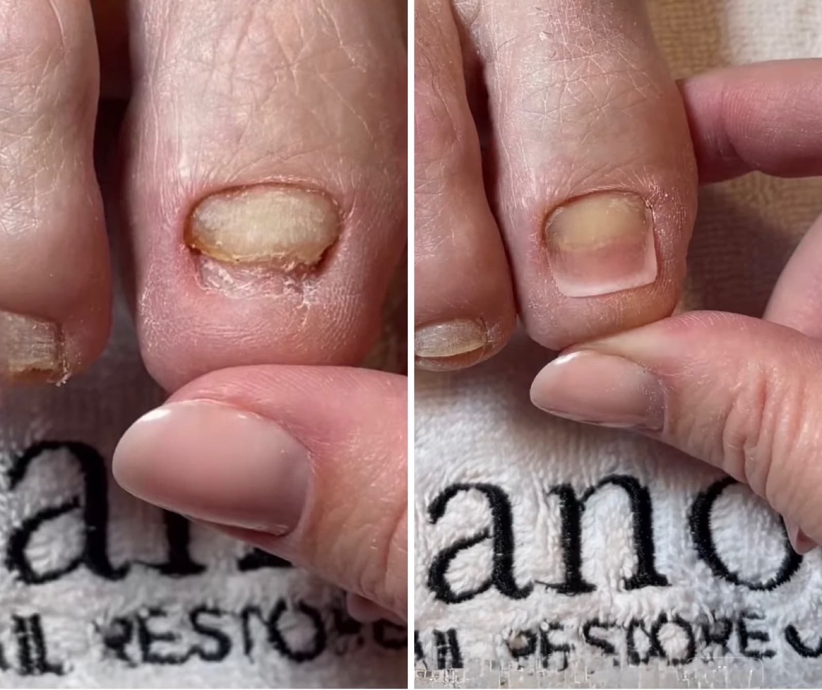 Nail Restoration & Reconstruction — Salmon Arm Aesthetics